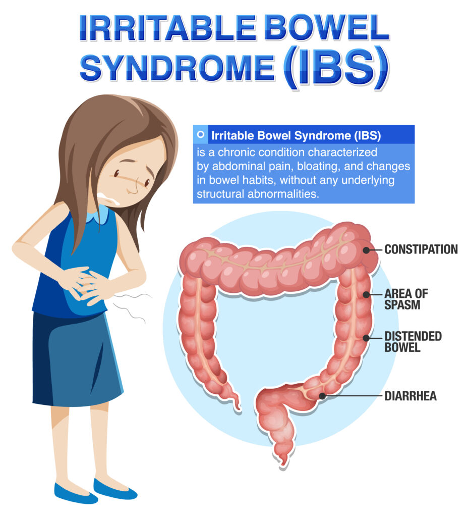 Irritable Bowel Syndrome (IBS) Infographic illustration