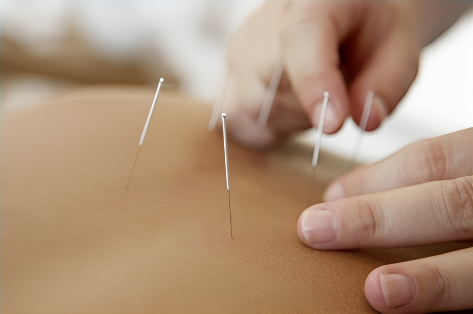 Shoulder Pain and Acupuncture