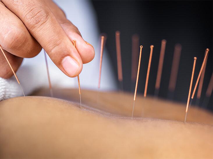 acupuncture